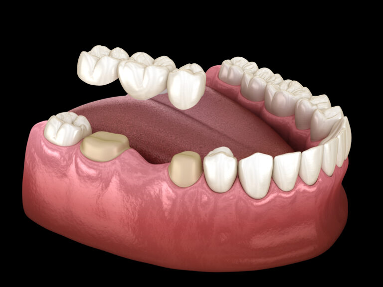 Dental Bridges at Eagle Falls Dentistry in Bloomingdale, IL.