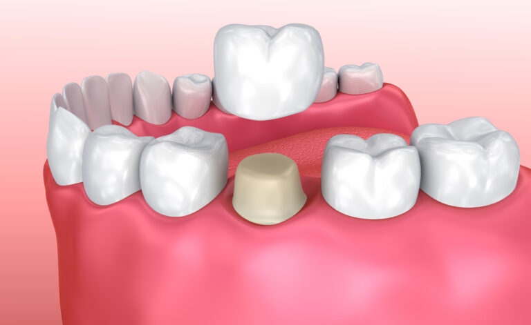 Dental Crowns at Eagle Falls Dentistry in Bloomingdale, IL.