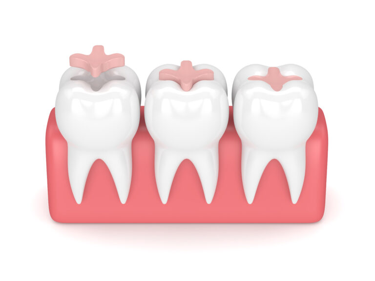 Dental Fillings and Dental Sealants at Eagle Falls Dentistry in Bloomingdale, IL.