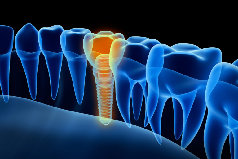 Dental Implants at Eagle Falls Dentistry in Bloomingdale, IL.