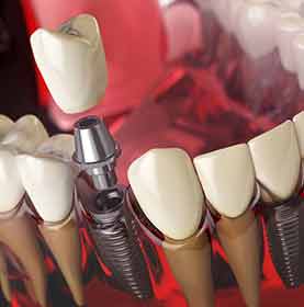 Dental Implants