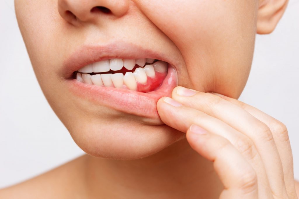 What is Periodontal Gum Disease