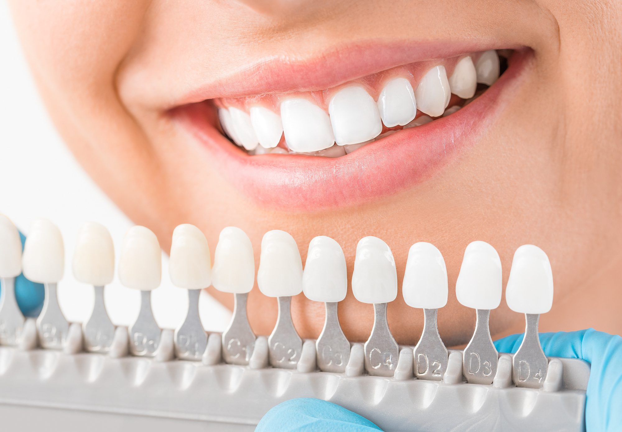 benefits-of-dental-crowns