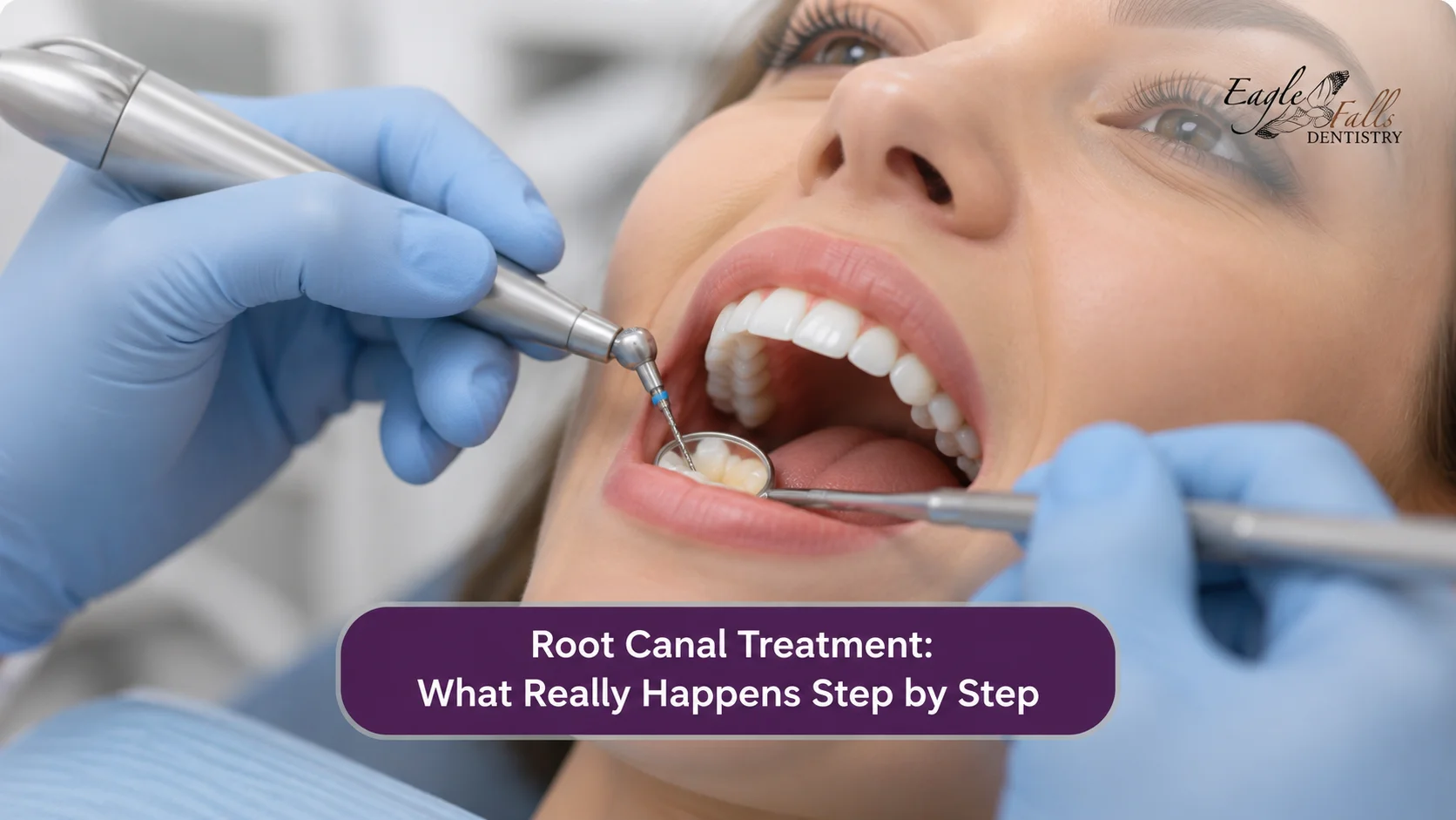 Root canal treatment step-by-step at Eagle Falls